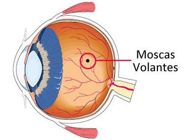 Moscas volantes en el ojo